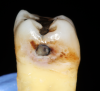 Fig 2. Cavitation of interproximal enamel.