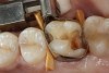Fig 6. Periphery of clean enamel and dentin with affected dentin left on pulpal floor and axial wall (photograph from Dr. Sarah Alhalees).
