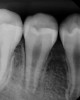 (3.) Preoperative radiograph of necrotic permanent tooth No. 29.