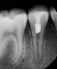 (4.) Immediate postoperative radiograph after second visit for regenerative endodontic treatment on tooth No. 29.