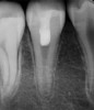(5.) Radiograph of tooth No. 29 taken 1 year after regenerative endodontic treatment.