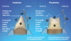 (1.) Ideal preparation design for chairside zirconia restorations (Figure recreated with permission from Glidewell Laboratories).