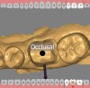 (6.) Margin marking/orientation, design, and nesting of the restoration in the block.