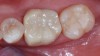 (10.) Occlusal and buccal views of the final restoration.