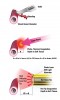 (2.) Coagulation and hemostasis mechanisms illustrated: (a) none for scalpel; (b) photothermal coagulation inside irradiated soft tissue; and (c) heat diffusion from the hot tip into the soft tissue.