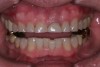 (3.) Either form of parafunction, whether conscious or unconscious, involves excessive rubbing together of the dentition.