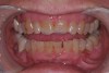 (8.) With pathologic wear, there will almost always be combinations of occlusal stress and disharmony, erosion, abrasion, parafunction, and attrition.