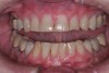 (11.) A patient presented with advanced generalized wear of her anterior teeth, and was displeased with their overall appearance because of their color and wear.
