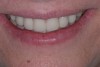 (20.) The provisional restorations show the vertical and horizontal changes in the incisal edge position.