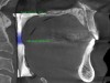 (3.) CBCT image of the patient’s airway.