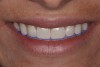 (2.) Close-up smile photo. The blue line shows the approximate smile line of the maxillary anterior teeth. Note how the smile line approximates the curvature of the lower lip.