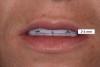 (3.) Rest position photo. In a youthful smile, 2 mm to 4 mm of the maxillary incisors will show when the lips are open and at rest. As a patient ages, the amount of incisal display will decrease at rest.