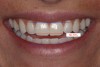 (4.) Exaggerated “E” photo. In this photo, the incisal edges should lie between 50% to 70% from the upper lip to the lower lip.