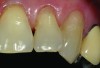 CASE 1 INITIAL RESTORATION STEPS (1.) Extensive root decay along teeth No. 10 and No. 11. (2.) Composite resin try-in was done to develop final layering sequence. (3.) Teeth were isolated and minimally invasive preparations were completed with minimally invasive burs. (4.) After a thin liner of resin-modified glass ionomer was placed, dentinal adhesive was bonded to the root in preparation for composite placement. (5.) To match the chromaticity along the gingival aspect, an opacious dentin shade (AO2) was bonded over the resin-modified glass ionomer to mimic the lost dentin.