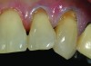 CASE 1 INITIAL RESTORATION STEPS (1.) Extensive root decay along teeth No. 10 and No. 11. (2.) Composite resin try-in was done to develop final layering sequence. (3.) Teeth were isolated and minimally invasive preparations were completed with minimally invasive burs. (4.) After a thin liner of resin-modified glass ionomer was placed, dentinal adhesive was bonded to the root in preparation for composite placement. (5.) To match the chromaticity along the gingival aspect, an opacious dentin shade (AO2) was bonded over the resin-modified glass ionomer to mimic the lost dentin.