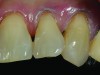 CASE 1 INITIAL RESTORATION STEPS (1.) Extensive root decay along teeth No. 10 and No. 11. (2.) Composite resin try-in was done to develop final layering sequence. (3.) Teeth were isolated and minimally invasive preparations were completed with minimally invasive burs. (4.) After a thin liner of resin-modified glass ionomer was placed, dentinal adhesive was bonded to the root in preparation for composite placement. (5.) To match the chromaticity along the gingival aspect, an opacious dentin shade (AO2) was bonded over the resin-modified glass ionomer to mimic the lost dentin.