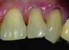 CASE 1 FINAL STEPS (6.) For final blending of this Class V restoration, a body shade of A2 was placed and blended to the enamel cavosurface. (7.) Preoperative view of Class V lesions on teeth No. 10 and No. 11. (8.) Postoperative final Class V restorations using modern minimally invasive dentistry techniques.