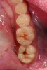 CASE 2 RESTORATIVE TREATMENT (9.) Failing Class I alloy restoration and fissure decay on lower molars. (10.) Modern minimally invasive dentistry preparations on both molars. Notice the moderate decay lesion under the failing alloy. (11.) After placement of resin-modified glass ionomer liner, an injectable composite resin is the ideal material for these conservative restorations.