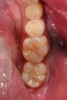 CASE 2 RESTORATIVE TREATMENT (9.) Failing Class I alloy restoration and fissure decay on lower molars. (10.) Modern minimally invasive dentistry preparations on both molars. Notice the moderate decay lesion under the failing alloy. (11.) After placement of resin-modified glass ionomer liner, an injectable composite resin is the ideal material for these conservative restorations.