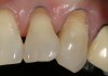 CASE 1 INITIAL RESTORATION STEPS (1.) Extensive root decay along teeth No. 10 and No. 11. (2.) Composite resin try-in was done to develop final layering sequence. (3.) Teeth were isolated and minimally invasive preparations were completed with minimally invasive burs. (4.) After a thin liner of resin-modified glass ionomer was placed, dentinal adhesive was bonded to the root in preparation for composite placement. (5.) To match the chromaticity along the gingival aspect, an opacious dentin shade (AO2) was bonded over the resin-modified glass ionomer to mimic the lost dentin.