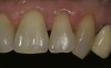 CASE 1 FINAL STEPS (6.) For final blending of this Class V restoration, a body shade of A2 was placed and blended to the enamel cavosurface. (7.) Preoperative view of Class V lesions on teeth No. 10 and No. 11. (8.) Postoperative final Class V restorations using modern minimally invasive dentistry techniques.