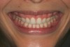 CASE 3 PRESENTATION (12.) The patient disliked her high, gummy smile and small teeth, some of which were angled severely inward. (13.) The previous orthodontic outcome left the patient’s arches extremely narrow and her smile line unesthetic. (14.) Loss of canine-protected function left the right side in group function. (15.) Group function on left side prematurely caused posterior occlusal wear and malocclusion. (16.) Traditional Le Fort I osteotomy had been recommended to the patient to reduce her vertical maxillary excess. (17.) When looking at this patient’s face, the vertical facial thirds appeared normal; however, her esthetic dental problem is evident. (18.) Inward-angled dentition leaves an unesthetic result in the facial profile view.