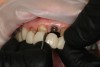 Fig 12. Removal of semi-permanent self-cure composite provisionals to restore teeth and osseointegrated implant No. 9.