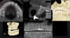 Fig 1. Different CBCT views allow the dentist to measure widths to determine whether an implant can be placed or whether bone regenerative procedures will be needed before or in conjunction with implant placement.