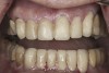 (21.) Provisionals, anterior, open view. Note the composite tops on the posterior teeth and improved planes of occlusion.