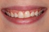 The patient was unhappy with the shape, size, color, and contours of her front teeth.