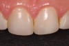 Tooth No. 9 displayed a large composite patch used to repair the broken composite veneer.