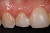 Localized moderate gingival inflammation was associated with poorly polished composites Nos. 7 and 8 (Fig 4) and Nos. 9 through 11 (Fig 5).