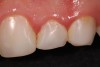 Localized moderate gingival inflammation was associated with poorly polished composites Nos. 7 and 8 (Fig 4) and Nos. 9 through 11 (Fig 5).