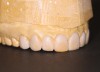 Wax-up with new gingival levels and proposed tooth size.