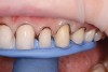 Preparation guide made from wax-up for proper incisal edge thickness.