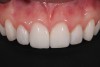 Final anterior porcelain veneers.