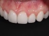 Final anterior porcelain veneers.