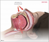 Depiction of a patient's airflow both before and after use of a mandibular advancement
device.