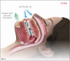 Depiction of a patient's airflow both before and after use of a mandibular advancement
device.