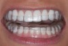 (6.) A dual arch B-splint in the mouth. The posterior teeth stay separated by the anterior platform. Both arches are fully retained and covered, which prohibits tooth movement.