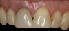 4. Facial and occlusal views of initial clinical presentation of tooth No. 8.