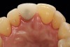 5. Facial and occlusal views of initial clinical presentation of tooth No. 8.
