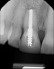 (6.) Pretreatment periapical radiograph.