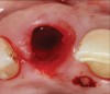 8. Tooth No. 8 with diagnosis of Grade III socket, requiring extraction followed by guided bone regeneration and a rotated pedicle flap to gain hard and soft tissue for future implant placement.