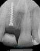 (12.) Radiograph of site No. 8 taken immediately after extraction, guided bone regeneration, and soft-tissue augmentation. Note the tenting screw placed to facilitate vertical bone gain and the bonded temporary Maryland bridge.