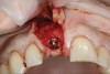(16.) Full-thickness flap elevation to expose the tenting screw and gain access for anticipated additional bone grafting following implant placement.