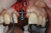 (17.) Implant placed 1-mm distal to the midline of the edentulous space, corresponding with the planned location of the gingival zenith. Note the lack of sufficient bone buccal to the implant that necessitated further grafting.