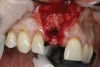 18. Horizontal guided bone regeneration using particulate bone allograft and a resorbable membrane to augment the buccal aspect of site No. 8.