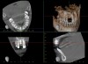 (22.) Immediate postoperative CBCT scan.