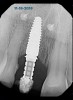 (25.) Facial view, distal view, and radiograph of the acrylic implant-retained provisional restoration placed at the implant uncovering surgery to contour the soft-tissue profile for final restoration. Critical and subcritical contours follow the anatomic crown profile as seen in both the mesiodistal and buccolingual dimensions.